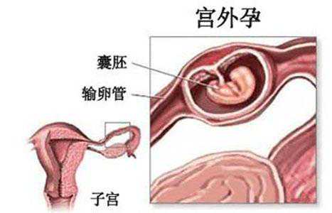 <b>子宫内异位症：输卵管左侧隐痛的背因</b>