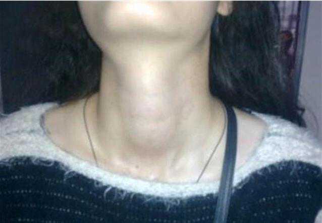 10岁小女孩长出“喉结”，竟然是甲状腺惹的祸