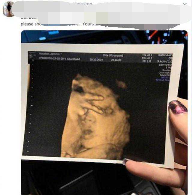 21岁孕妇做产检时，胎宝跟她比了个“耶”，医生：真少见、太可爱